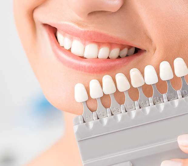 San Juan Capistrano Dental Veneers and Dental Laminates